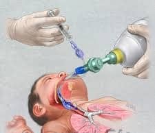 laryngeal mask in children